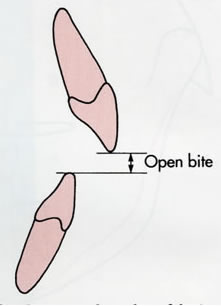 Open Bite illustration