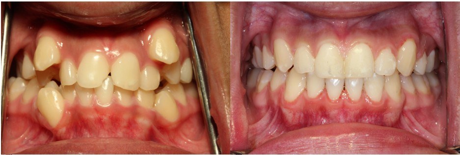 Orthodontic before and after — case 1