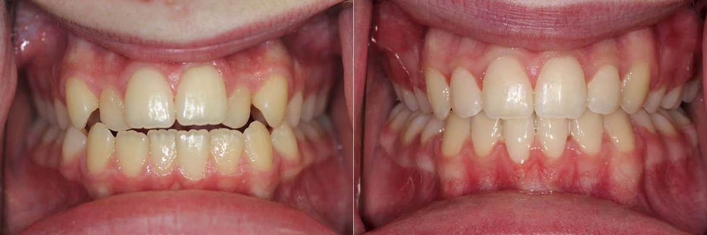 Orthodontic before and after — case 2