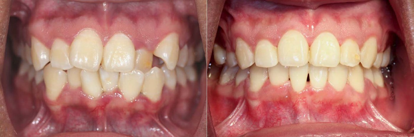 Orthodontic before and after — case 3