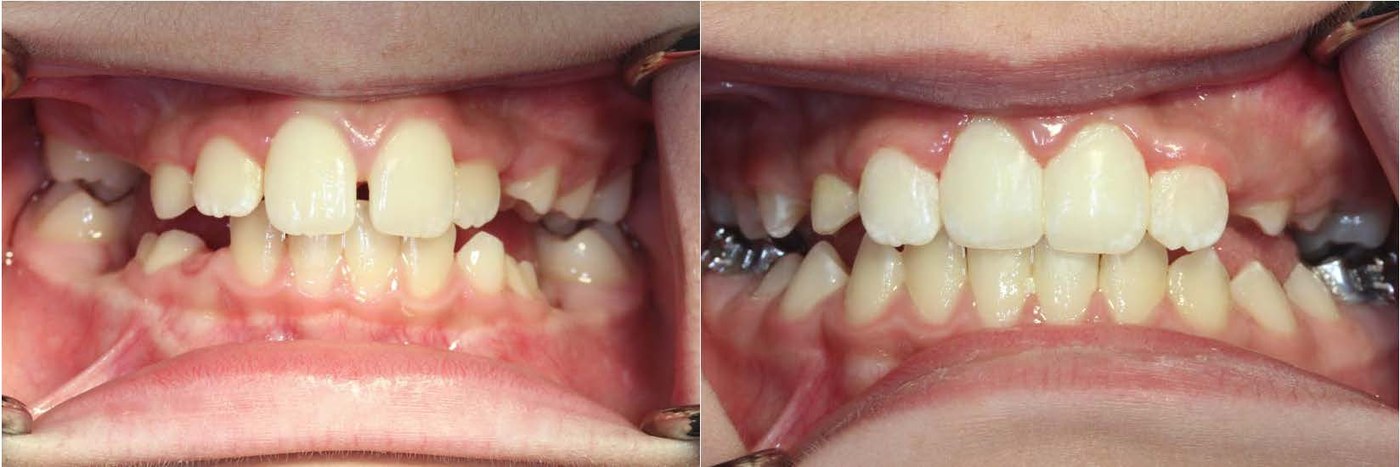 Orthodontic before and after — case 4