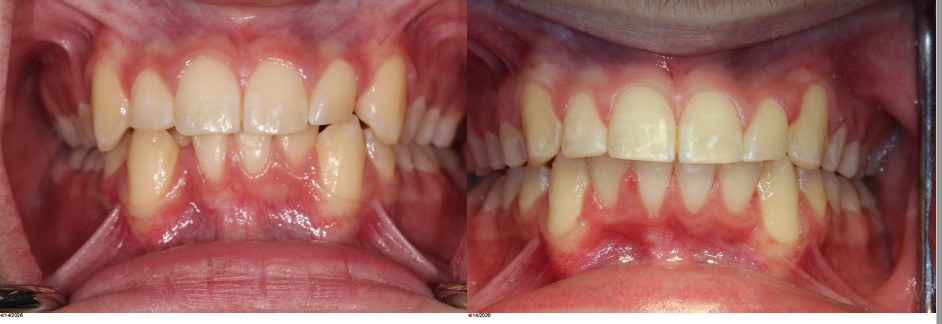 Orthodontic before and after — case 5