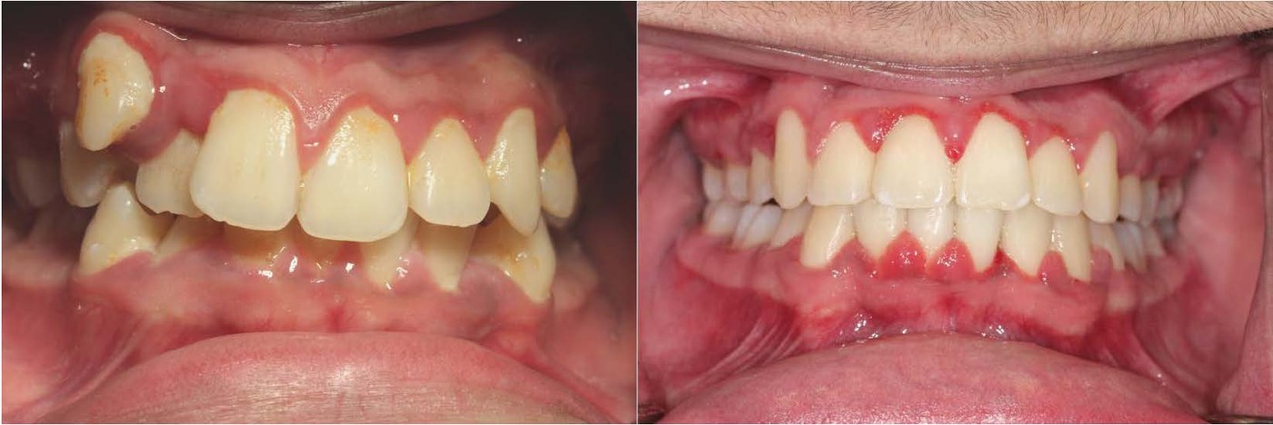 Orthodontic before and after — case 7