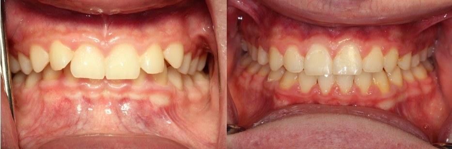 Orthodontic before and after — case 8