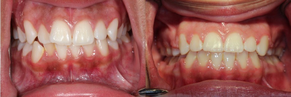 Orthodontic before and after — case 9