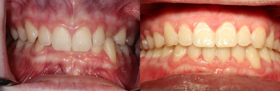 Orthodontic before and after — case 10