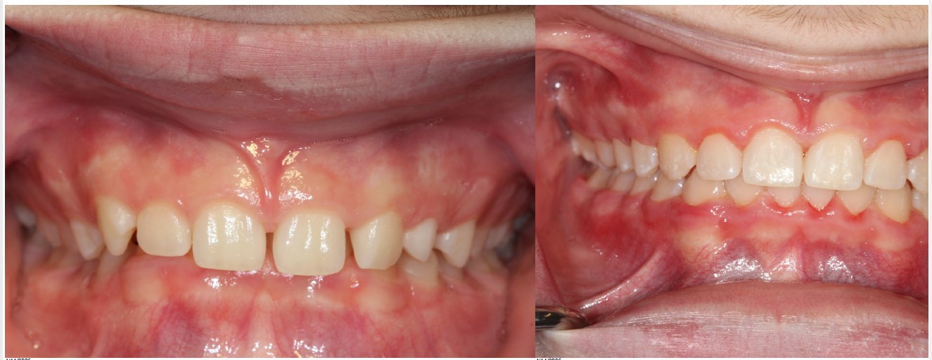 Orthodontic before and after — case 12