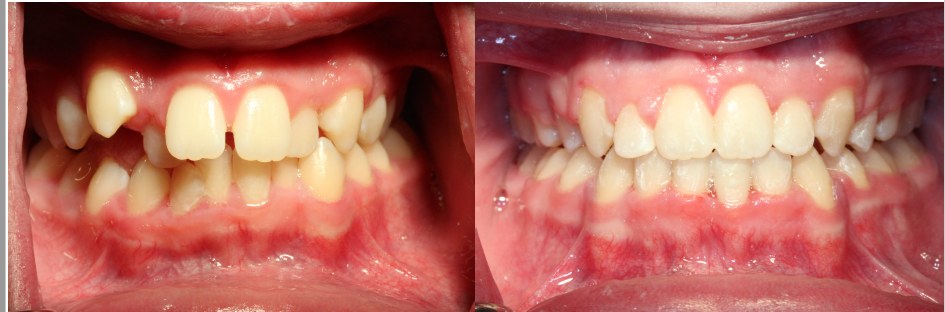 Orthodontic before and after — case 13